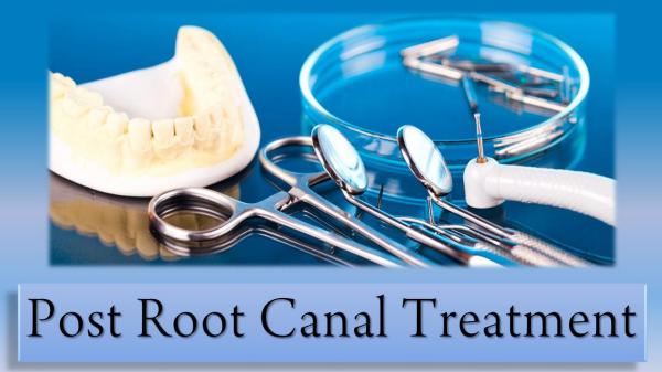 Post Root Canal Treatment Post Root Canal Treatment