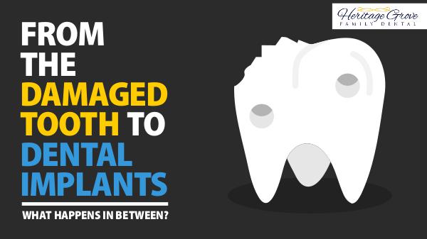 From The Damaged Tooth To Dental Implants: What Happens In Between? Dental Implants