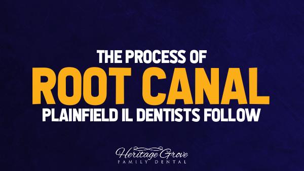 Root Canal Plainfield IL The Process of Root Canal, Plainfield IL Dentists