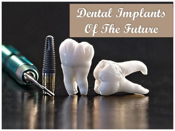 Dental Implants Of The Future Dental Implants Of The Future