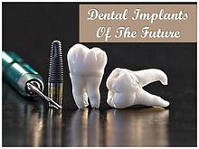 Dental Implants Of The Future