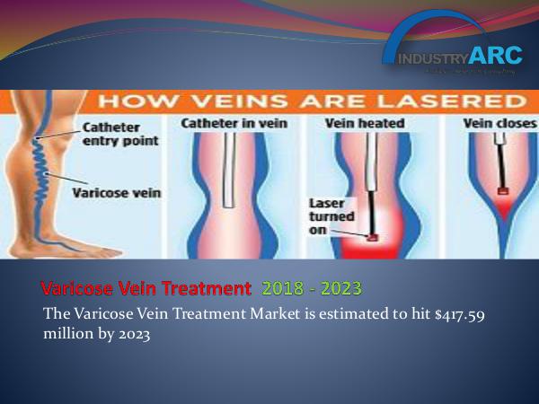 Analytics, Research & Consulting Varicose Vein Treatment Market