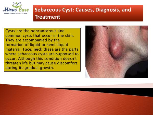 Dr. Mir Asif Rehman Sebaceous Cyst CausesDiagnosis, and Treatment-conv